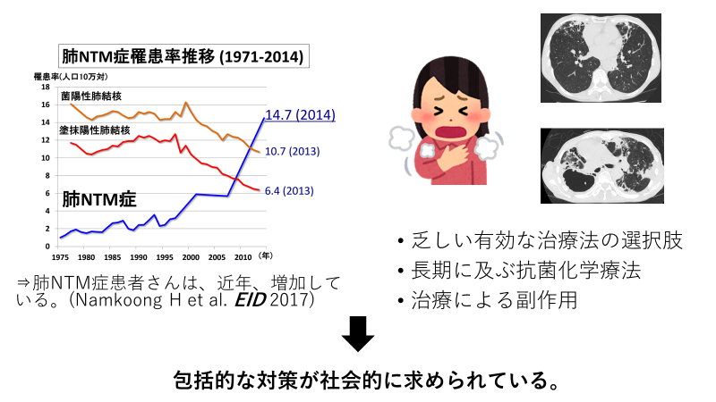 近年急増する難治性呼吸器感染症、肺MAC症の発症に関わる遺伝子を発見